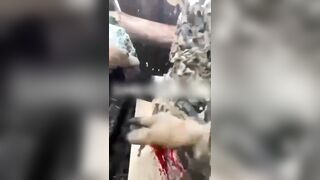 Torn hand