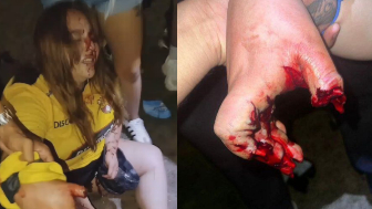 Woman Loses Finger After Firework Explosion