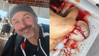 Italian Tourist Critically Injured By Boat Propeller In Colombia