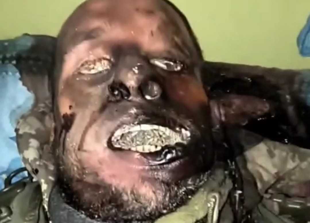 Ukrainian junkie with maggots.