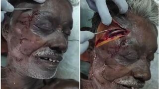 Indian old man autopsy