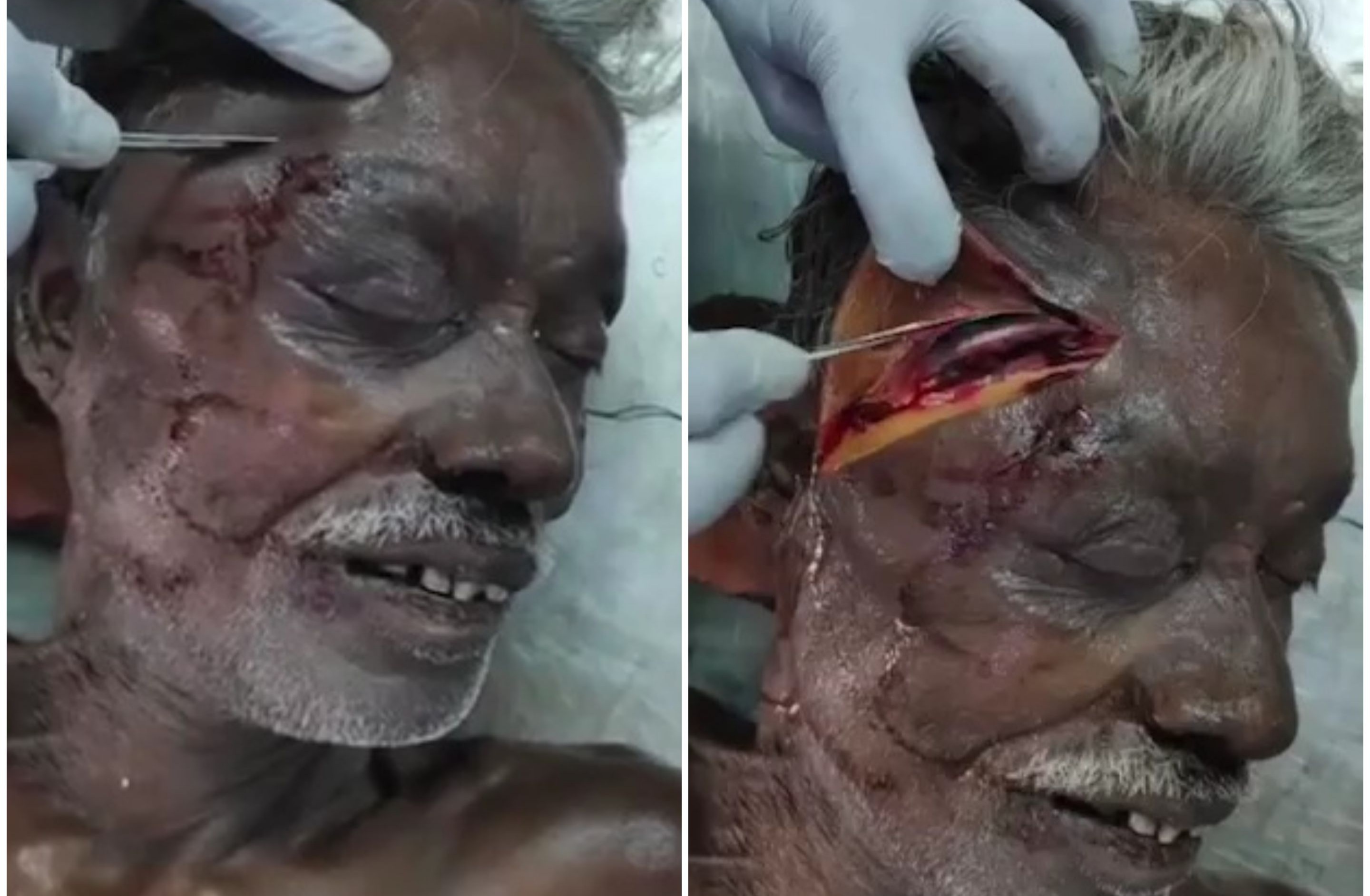 Indian old man autopsy
