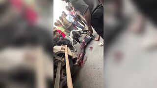 TERRRIBLE: Fully Awake Man Suffers Nasty Injuries Following Truck Accident In Africa