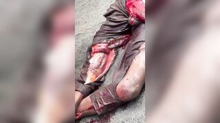 TERRRIBLE: Fully Awake Man Suffers Nasty Injuries Following Truck Accident In Africa
