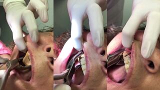 Dentist removes extreme 'tartar' from womens teeth