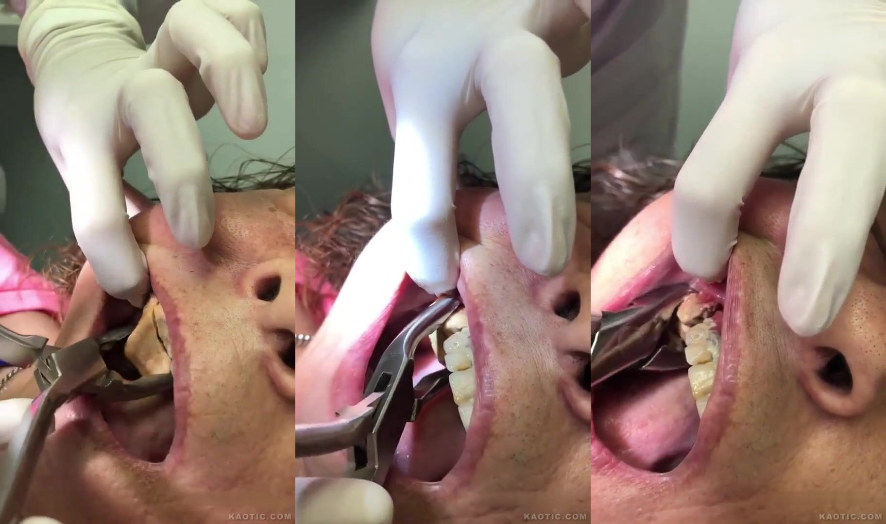 Dentist removes extreme 'tartar' from womens teeth