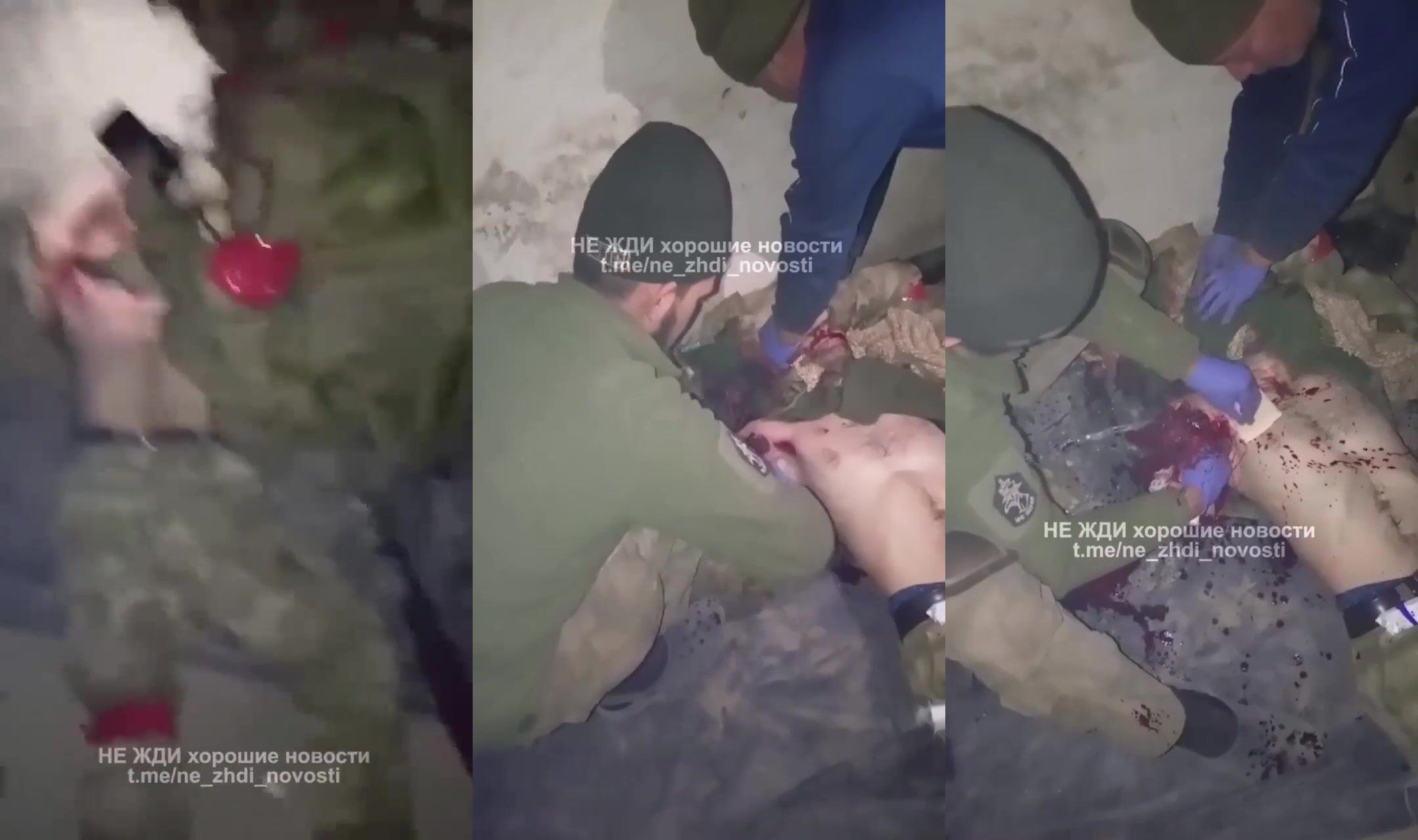 A wounded russian invader undergoes an arm amputation performed with a knife
