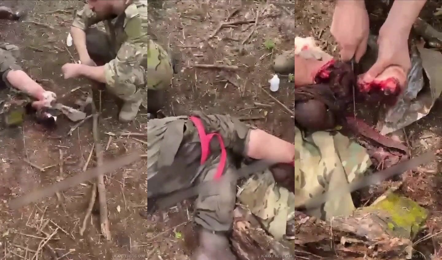 Field Amputation, No Anesthesia