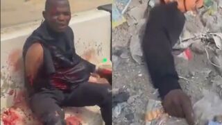 Delivery Man Is Fully Awake After Losing Arm In Traffic Accident