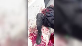 Delivery Man Is Fully Awake After Losing Arm In Traffic Accident