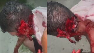 Man Literally Falls Apart After Machete Attack