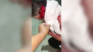 Man Literally Falls Apart After Machete Attack