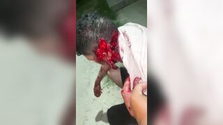 Man Literally Falls Apart After Machete Attack