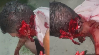 Man Literally Falls Apart After Machete Attack