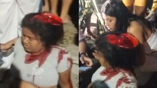 Woman Scalped After Serious Motorcycle Accident