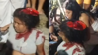 Woman Scalped After Serious Motorcycle Accident