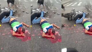 Motorcycle Accident Left Man With Head Shattered