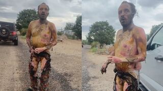 Texas:  Man suffers severe burns following basement gas explosion