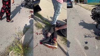 Riding harley breaks leg