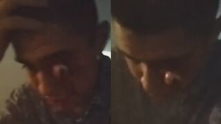 Drunk Driver`s EYE Popped Out After Traffic Accident