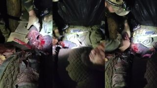 Improvised amputation of Russian soldier’s arm
