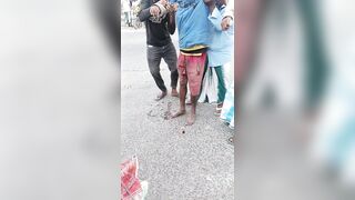 Wrong Way To Treat Accident Victim With Open Fracture