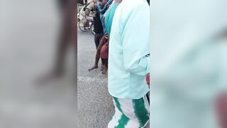 Wrong Way To Treat Accident Victim With Open Fracture