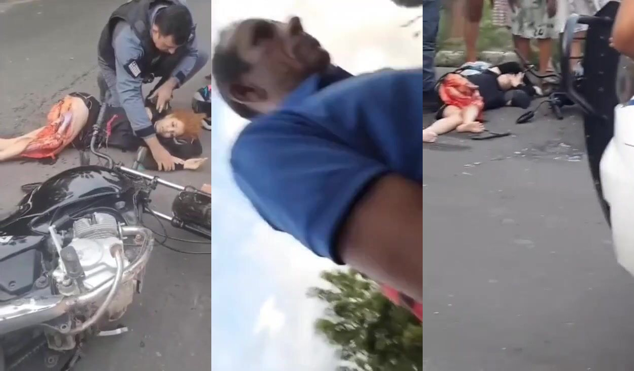 CLASSIC Motorcycle Accident Rips Open Woman's Leg, Exposing Her Femur.