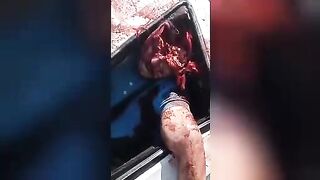 Man Driver Lost His Brain In A Car Accident