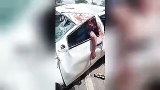 Man Driver Lost His Brain In A Car Accident