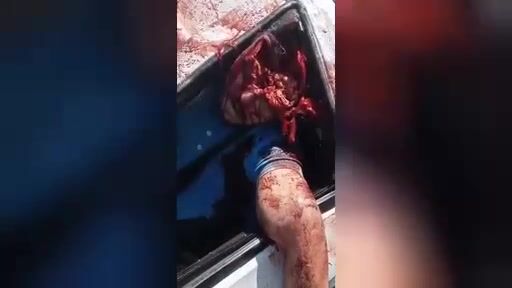 Man Driver Lost His Brain In A Car Accident