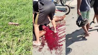 Woman Lost Hand In Motorcycle Accident