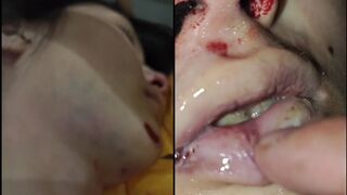 Insepcting 22 years old Chinese girl who died in accident in the morgue