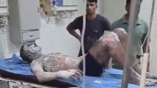 Workers Burned by Boiling Oil During Transformer Replacement