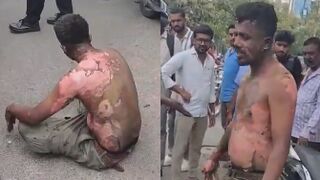 Man Attempted Self Immolation After GF Rejected Him