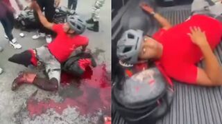 Man Is Fully Awake And Calm After Losing Limb In Motorcycle Accident In Venezuela