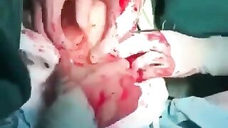 Huge Dildo Surgically Removed