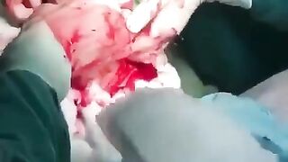 Huge Dildo Surgically Removed