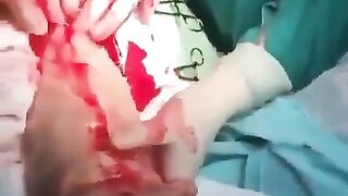 Huge Dildo Surgically Removed