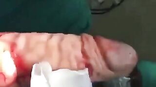 Huge Dildo Surgically Removed