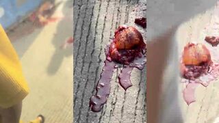 Man Crushed Under Container & Heart Still Beating