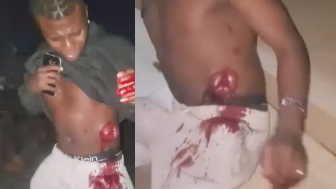 Man Walks With Guts Exposed After Being Stabbed