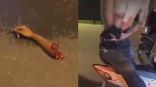 Man Lost His Arm During Clash Between Local Gangs In Vietnam