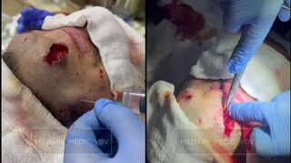 Russian wounded soldier hospitalized