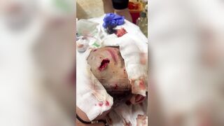 Russian wounded soldier hospitalized