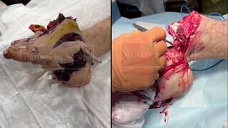 Russian soldier foot amputed after stepping on a landmine
