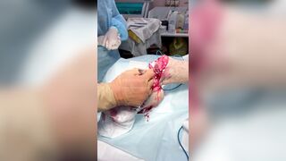 Russian soldier foot amputed after stepping on a landmine