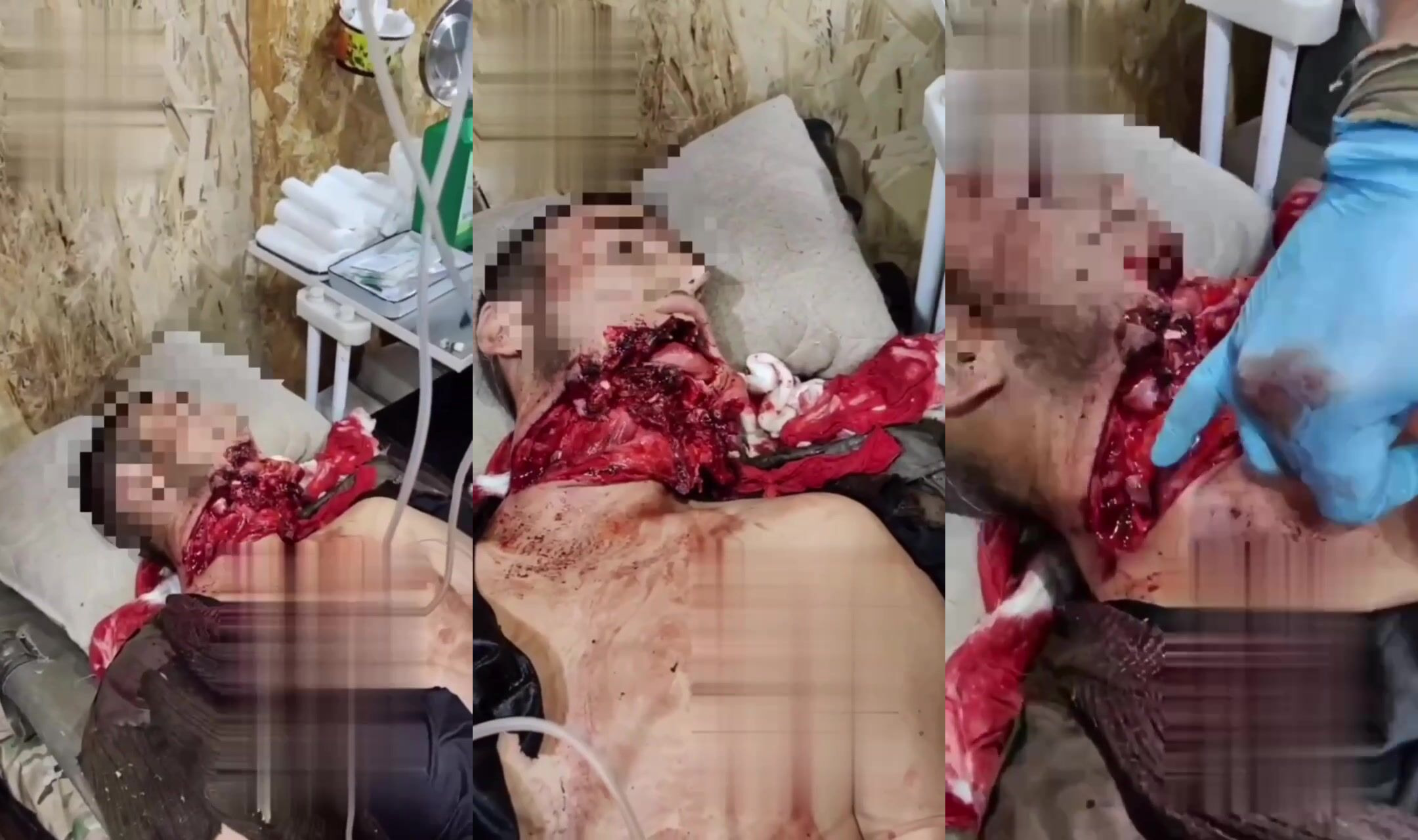 Soldier had his jaw blown off