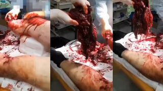 Soldier had his leg blown off