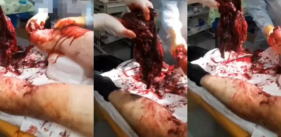 Soldier had his leg blown off